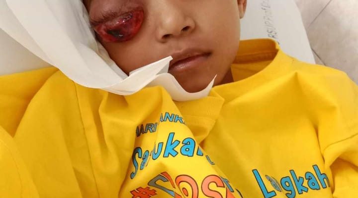 Terkena Kanker Mata, Bocah Asal Bobanehena Ini Butuh Bantuan Dermawan
